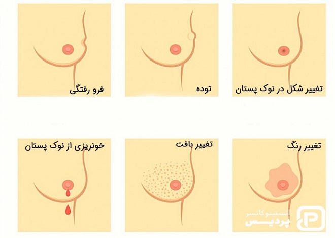 سرطان سینه