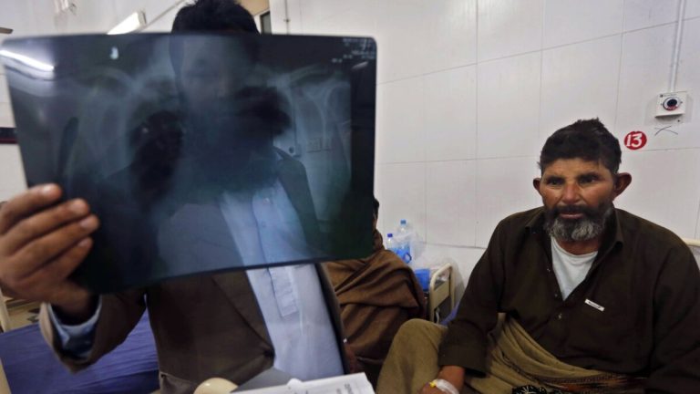 Más de 50,000 personas en Afganistán se han visto afectadas por la tuberculosis en un año