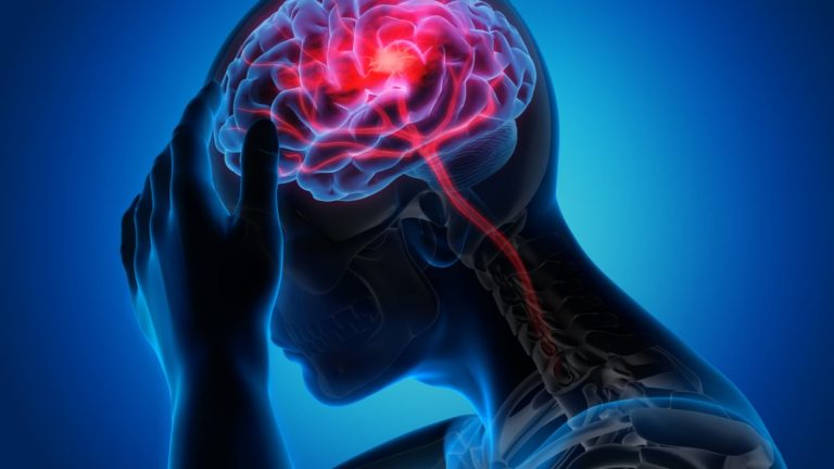 ¿Cómo se puede tratar un derrame cerebral?